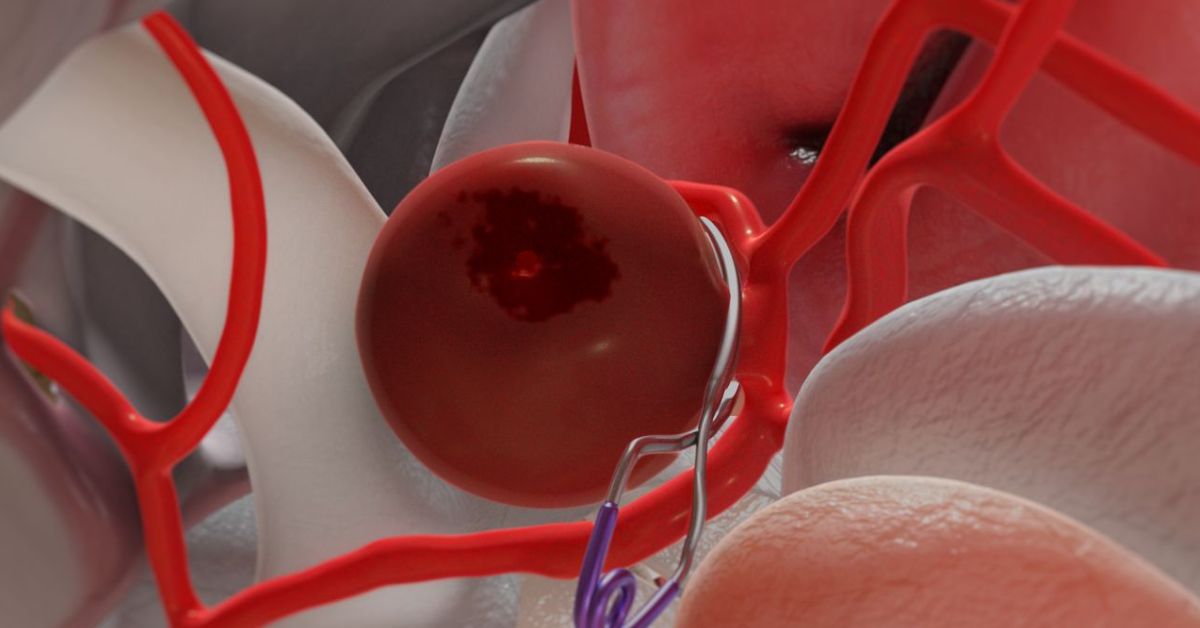 Understanding Aneurysm: Causes, Diagnosis, Prevention, and Lifestyle